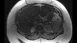 Hepatic Steatosis [upl. by Smada258]