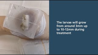 Larval Therapy application using bagged larvae for wound debridement [upl. by Cram404]