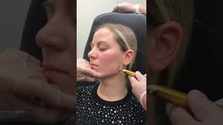 Jawline Filler Injection Technique by Dr Tina Ho [upl. by Annawat355]