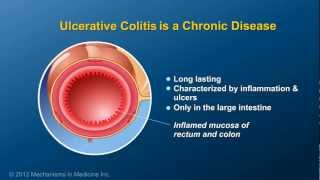 What is Ulcerative Colitis [upl. by Aiynat445]