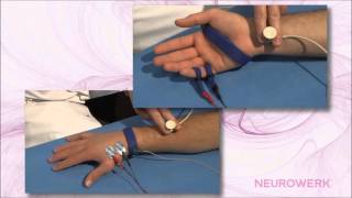 Sensory Neurography  Median Nerve [upl. by Yecaj]