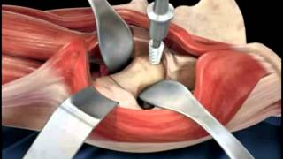 Hip replacement surgery techniques  Dr Scott Devinney [upl. by Aikas]