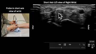 Median Nerve Anatomy and USGuided Injection [upl. by Eelinnej]