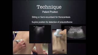 US Guided thoracentesis CUSE 2018 [upl. by Gav]